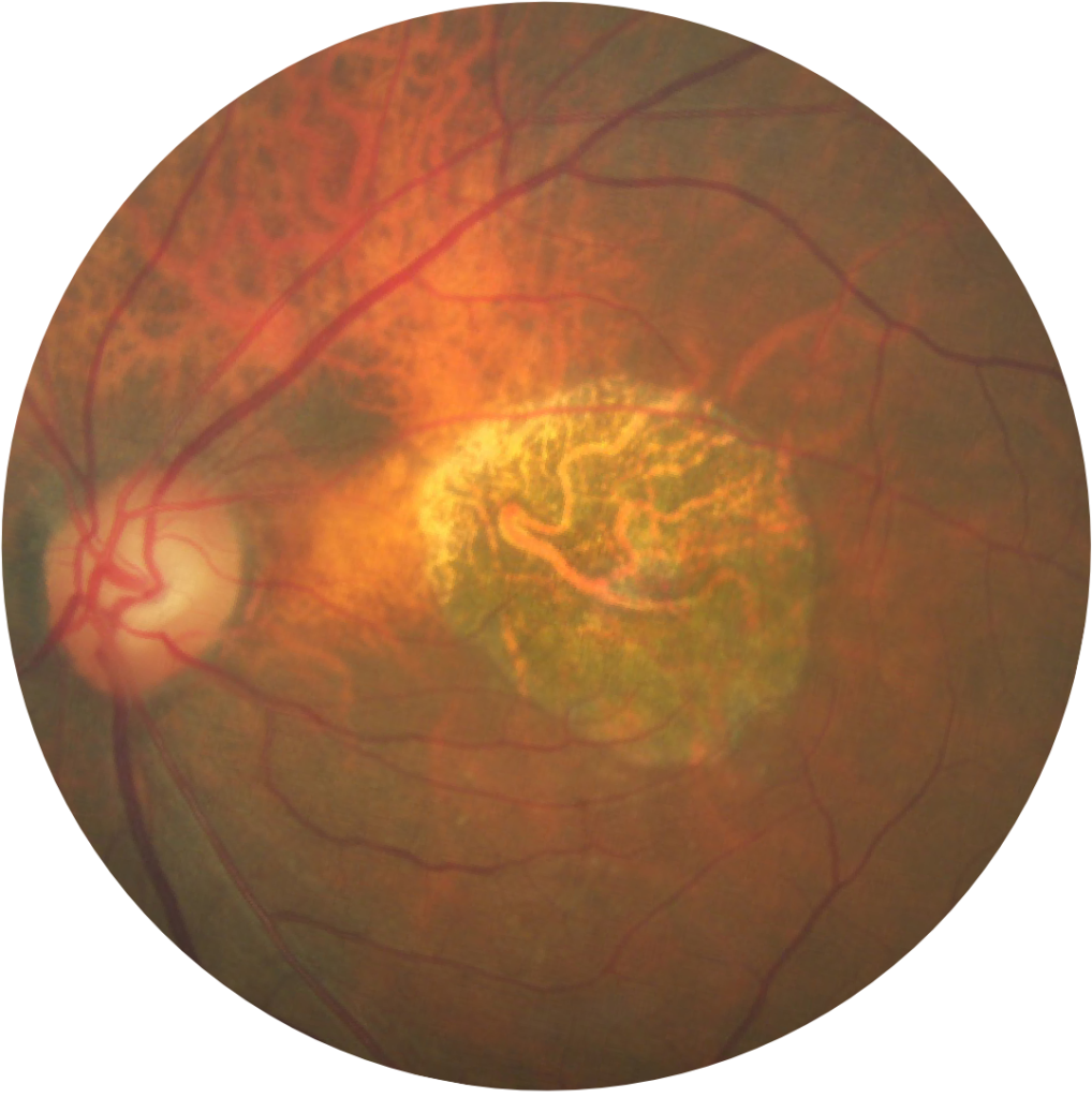 geographischeatrophie.de - unhealthy_fundus